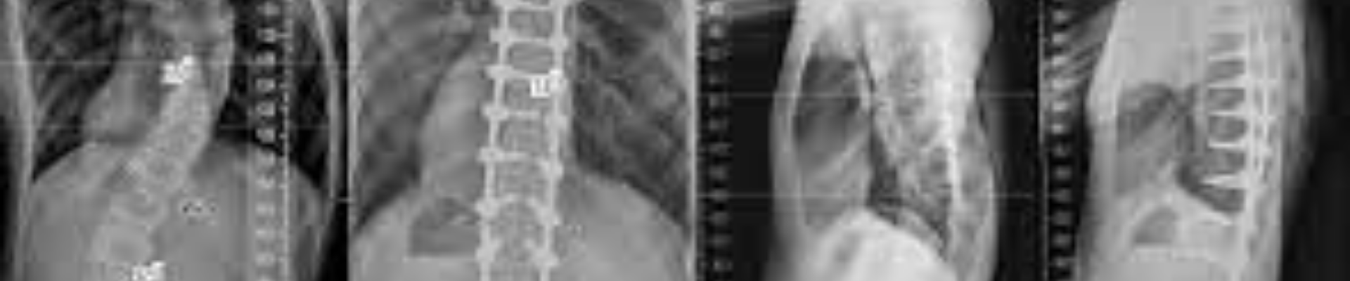 عملية تعديل اعوجاج العمود الفقري في الهند